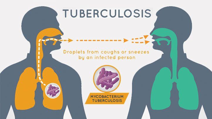 Mengenal Penyakit Tuberkulosis Dan Cara Mengobatinya - Informasi Berita ...